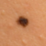 Melanoma exhibiting the Ugly Duckling Sign meaning it would be out of step with the person's other moles in color or size