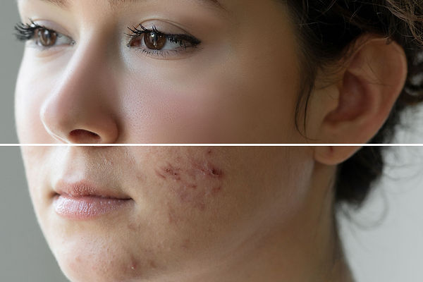 Acne female before and after iStock-1330382665 (2) cropped and edited 07312022.jpg