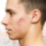 Severe Acne can lead to scarring if not promptly diagnosed.