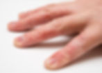 Dyshidrotic Dermatitis treatment often involves courses of oral steroids