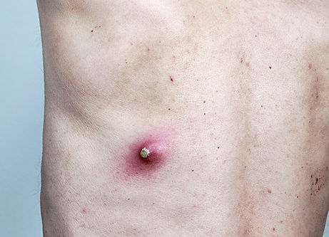 Caucasian male infected back cyst iStock-1137470872 cropped 06272019.jpg