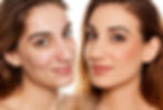 Systemic Acne Treatment Makes a Real Difference