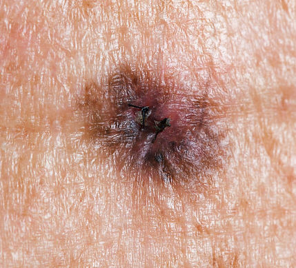 Melanoma iStock-155131938 cropped 03312019.jpg
