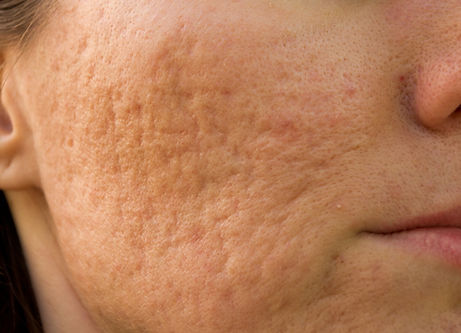 Acne scarring on cheeks iStock-179598340 09102018.jpg