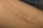 A Keloid or a Keloid Scar on a person's shoulder