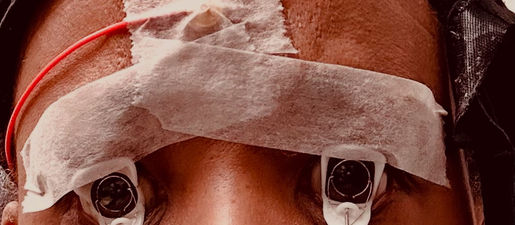 "Why I Needed an mfERG Test After 20+ Years on Hydroxychloroquine: Protecting Your Vision from Retinal Toxicity"
