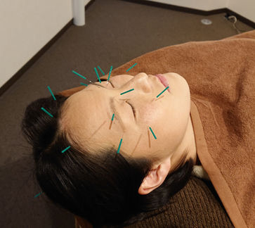 眼精疲労鍼