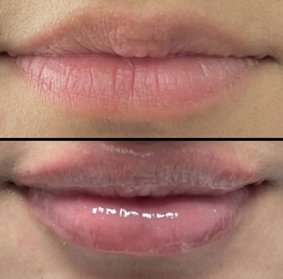 lip fillers