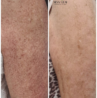 Pigment reduction and removal arms.jpg