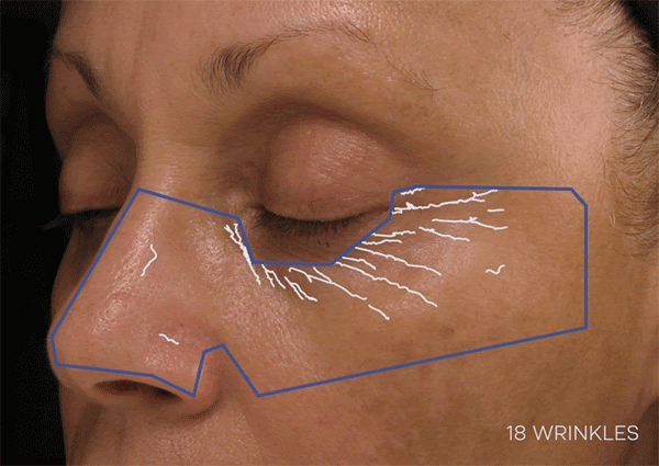 LightStim Anti-Age Treatment @ Enhancements by Donna Inc.