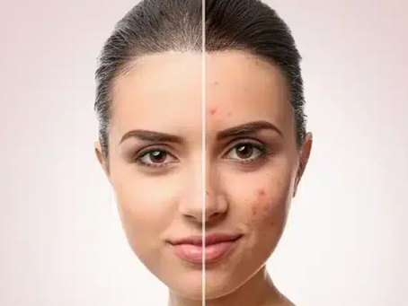 Effective Acne Treatment Approaches That Really Work for Teens