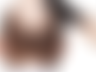 Who Should Choose Hair Transplant for Long Term Hair Restoration