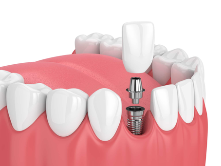 Full Mouth Dental Implants Cost Explained for Worry-Free Smiles