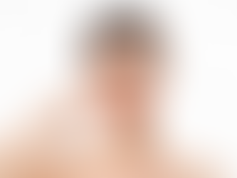 Step by Step Guide to Rhinoplasty for Lasting Satisfaction