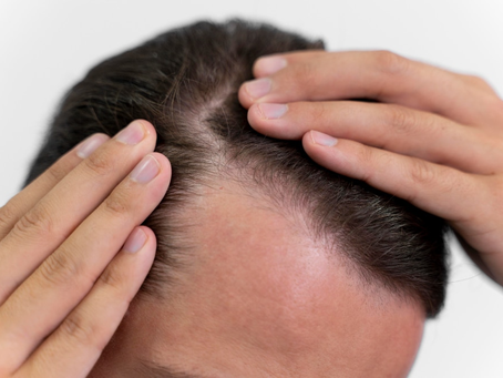 How Hair Transplant Helps Achieve Thicker Hair and Stress Relief