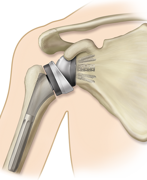 patients_shoulder-replacement_reverse-implant-illustration.png