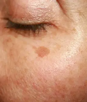 pigmentation-sally.webp