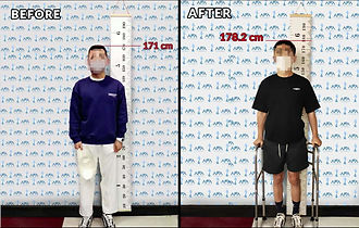 Limb Lengthening | AFA Limb Lengthening