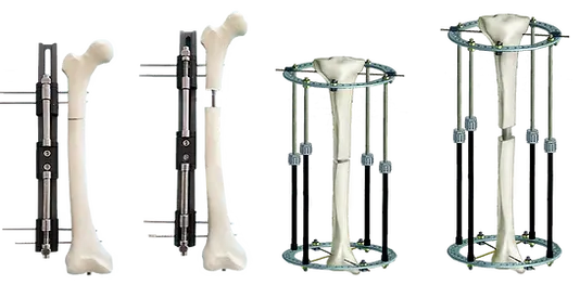 limb lengthening lon method