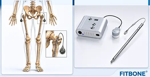FITBONE-afa.webp