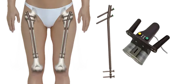precice-2-limb-lengthening-afa.webp
