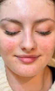dermalux after