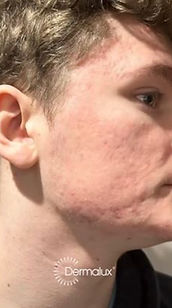 after dermalux treatment