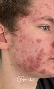 before dermalux treatment