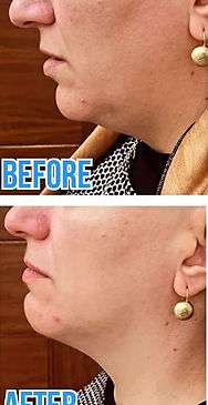 before after HIFU facing left.JPG