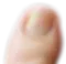 Mittlerer Schweregrad Nagelpilz - Nagelmatrix leicht betroffen