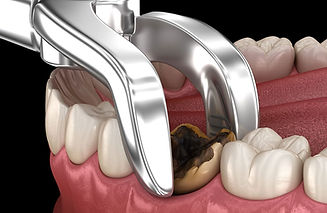 tooth-extraction-healing.jpg