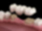 example of a dental bridge