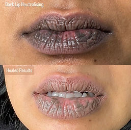 Lip Neutralising