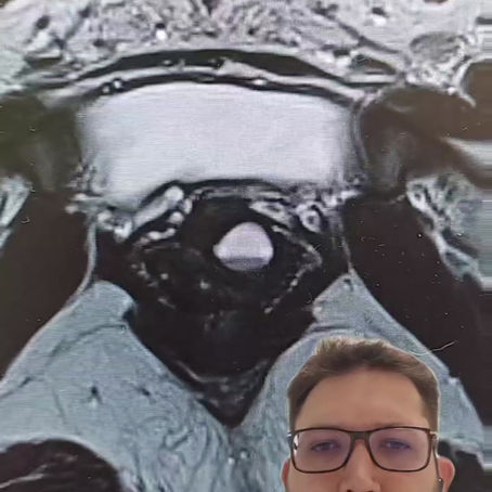 Divertículo de Uretra Feminina