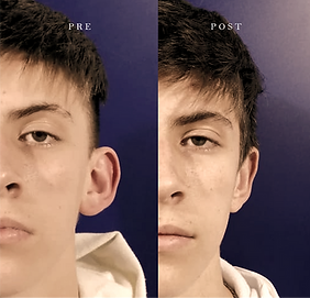otoplastia}_edited.png