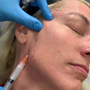 Sculptra for Gradual Volume and Collagen Boost