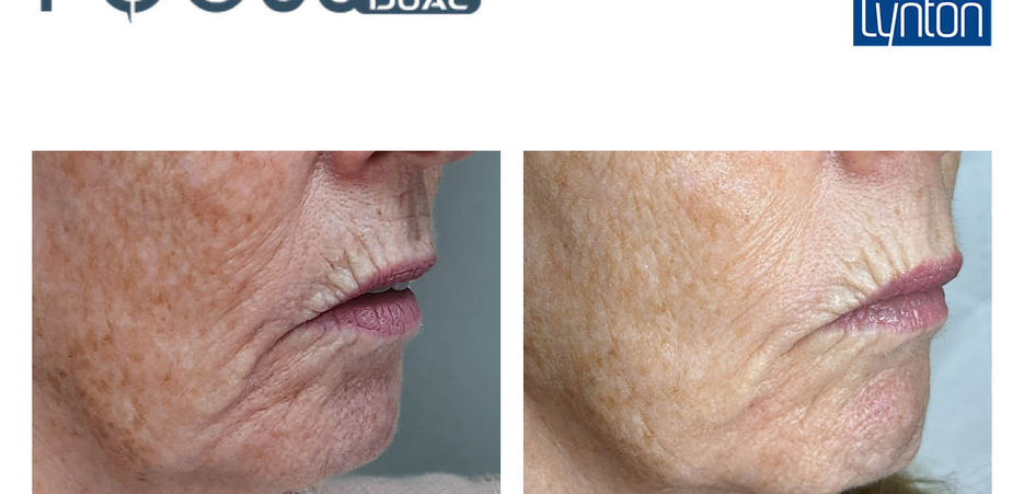 RF microneedling