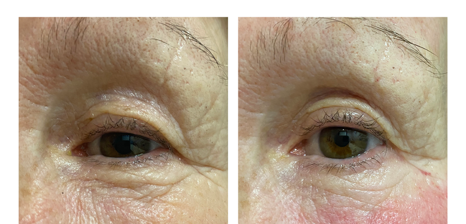 microneedling in belgravia
