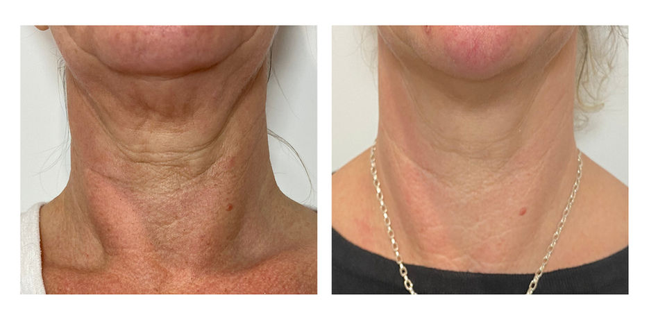 rf microneedling london