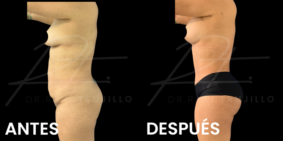 Abdominoplastia antes y despues guadalajara