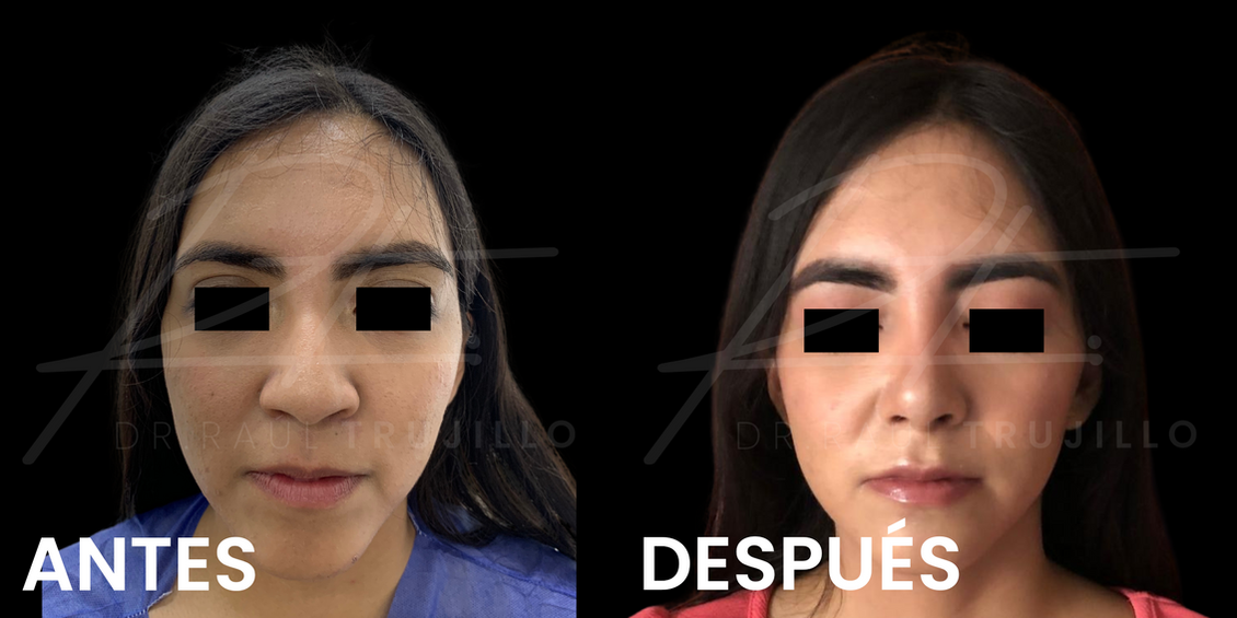 Rinoplastia antes y despues Guadalajara