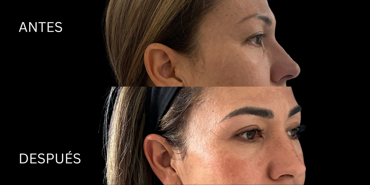 blefaroplastia antes y despues guadalajara
