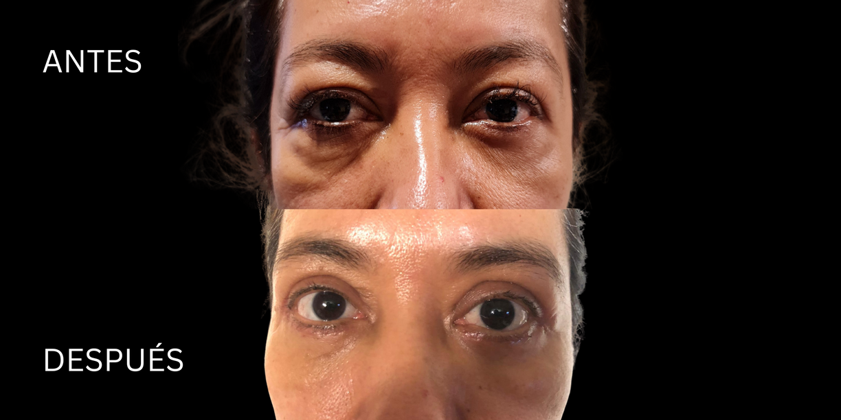 blefaroplastia antes y despues guadalajara