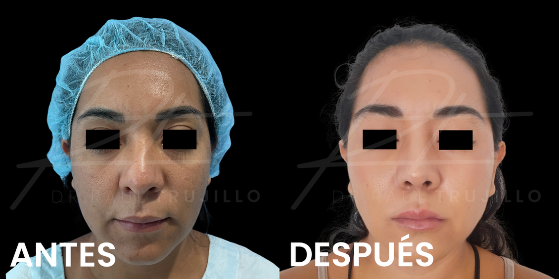 Rinoplastia antes y despues Guadalajara