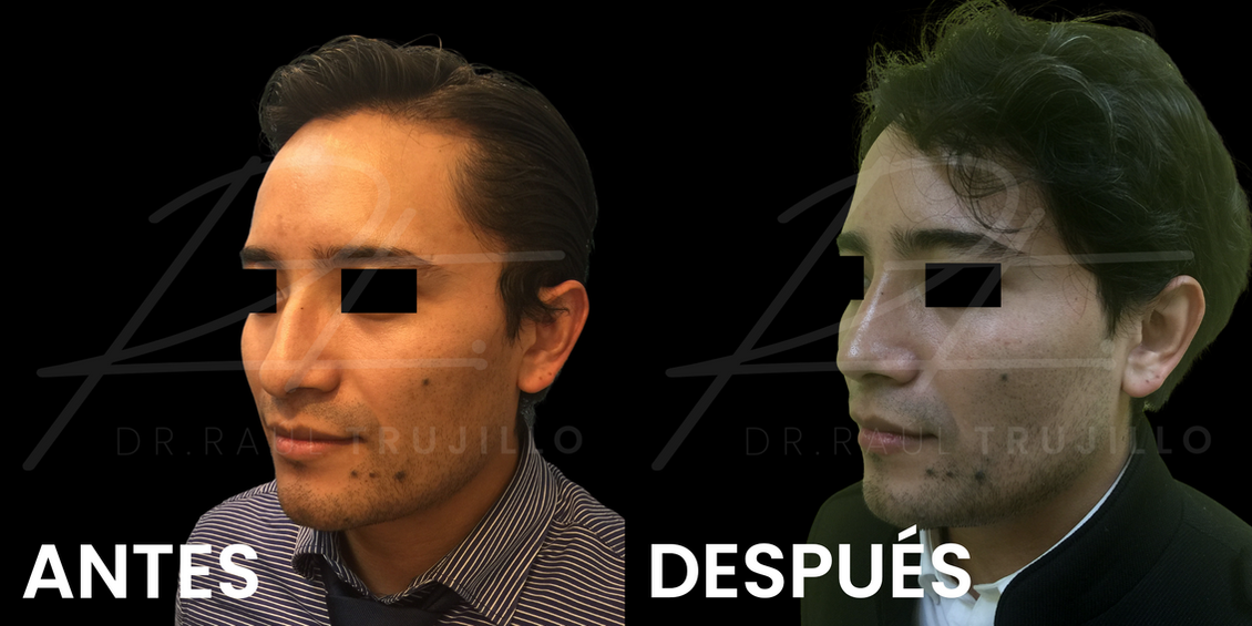 Rinoplastia antes y despues Guadalajara