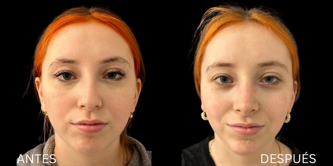 Rinoplastia antes y despues Guadalajara
