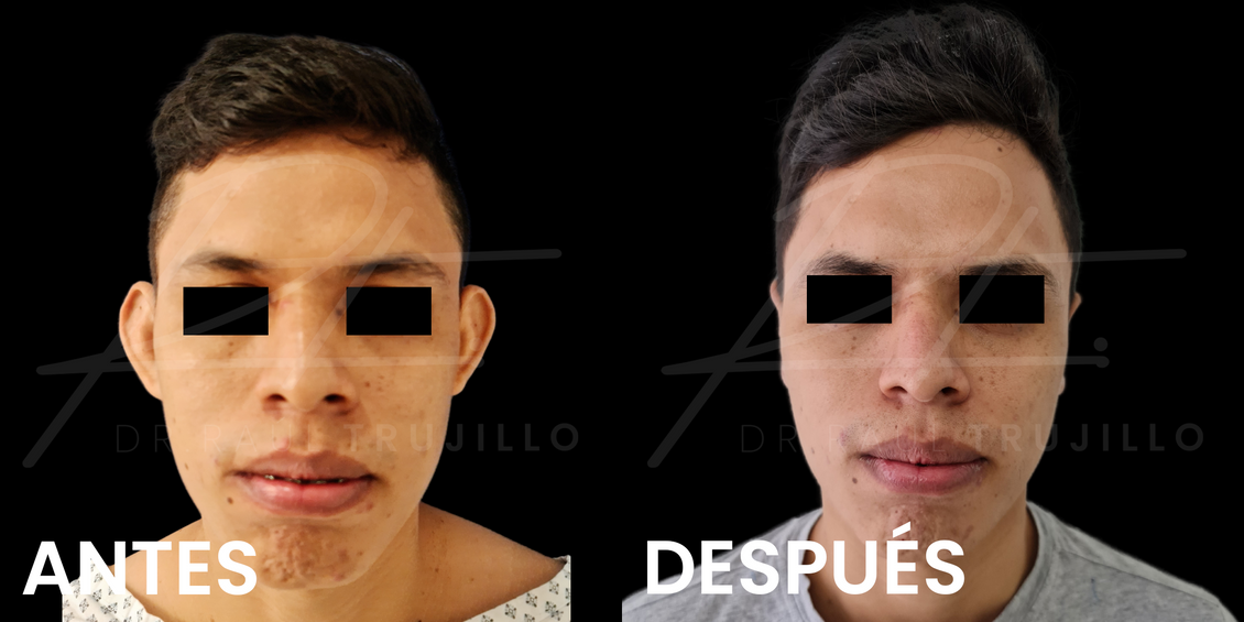 foto otoplastia antes y despues guadalajara