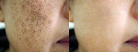 melasma-antes-depois.jpg