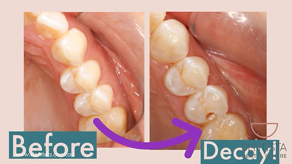 Before and after picture of drilling away a cavity.JPG
