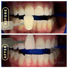 Zoom! In-Chair Whitening